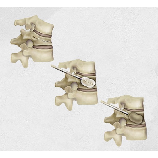 Kyphoplasty Kyphoplasty