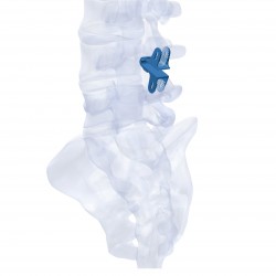 Interspinous Device